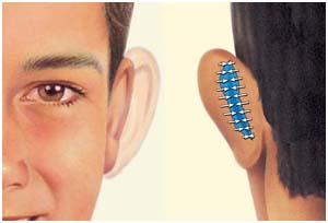 Cosmetic Ear Surgery, Otoplasty Ear Medical Treatment Kolkata India, Otoplasty Ear Surgery Cost India